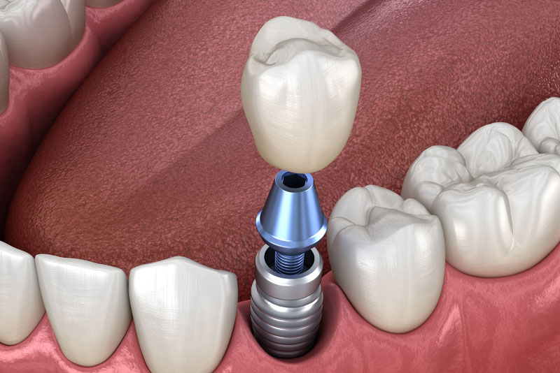 The Advancements and Benefits of Tooth Implants in Fort Lauderdale, FL